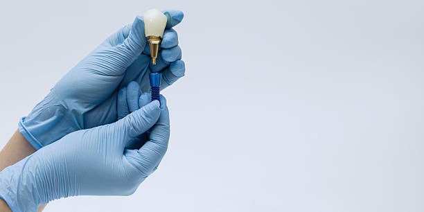 7 Things To Know Before Getting Dental Implants Abroad