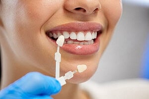 How To Avoid Fake-Looking Veneers: Shade, Shape, And Smile Design Tips