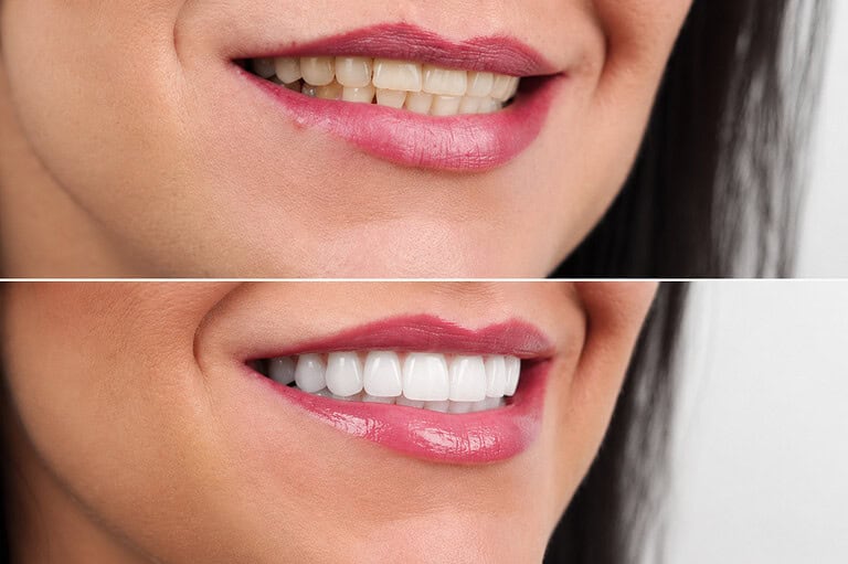 Smile Makeover Albania: Combining Whitening, Veneers and Gum Treatment